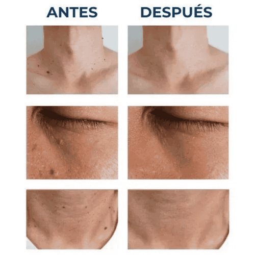 🔝Elimina tus verrugas desde casa sin procedimientos doloroso